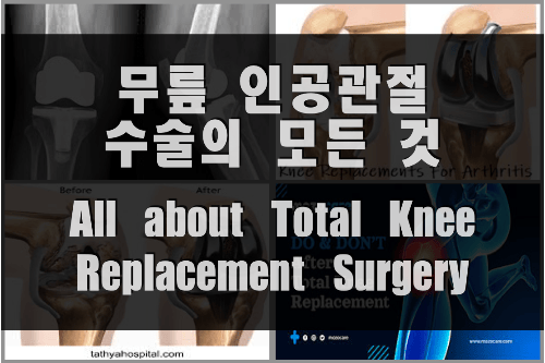 0 무릎 인공관절 수술 썸네일