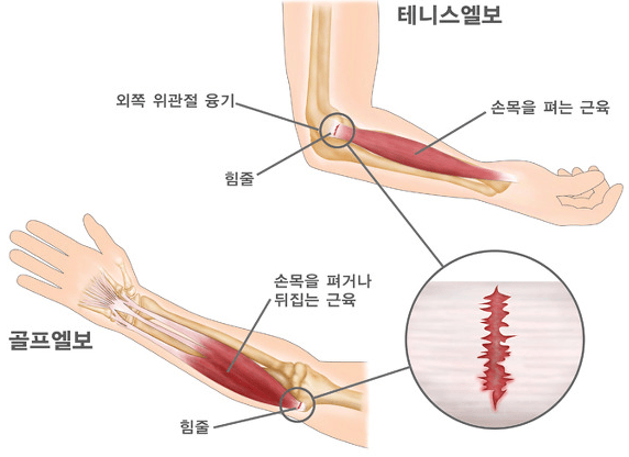 내외상과염 구분 그림