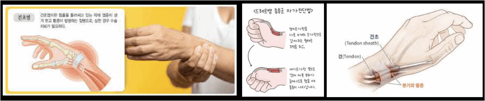 손목건초염의 원인과 증상, 진단과 치료 1 손목건초염의 설명그림