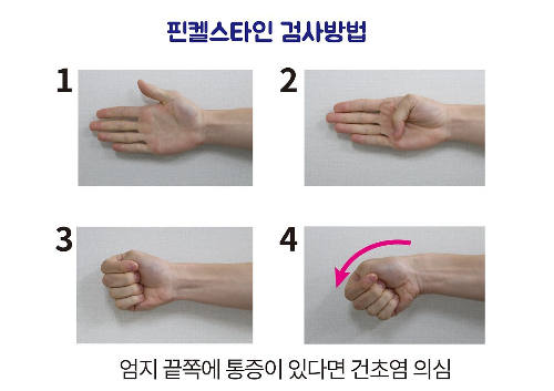 손목건초염의 원인과 증상, 진단과 치료 2 핀켈스타인 검사방법