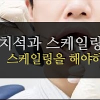 특성_치석과 스케일링
