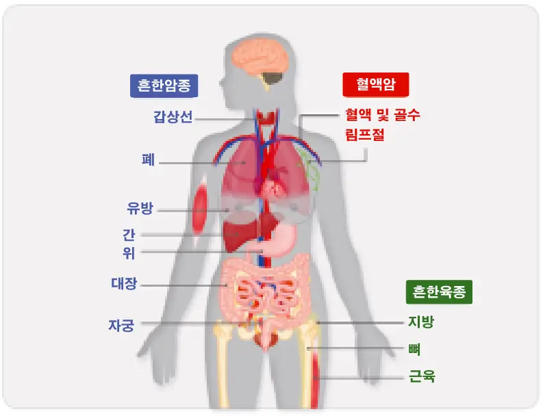 암, cancer 종류