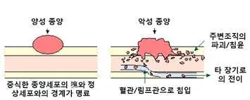 cancer 양성 악성 종양 차이 그림