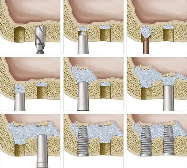 임플란트 상악동거상술