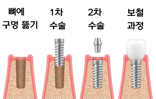 임플란트 수술 절차